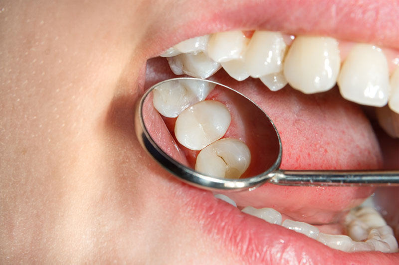 Dental Sealants in Vancouver, WA